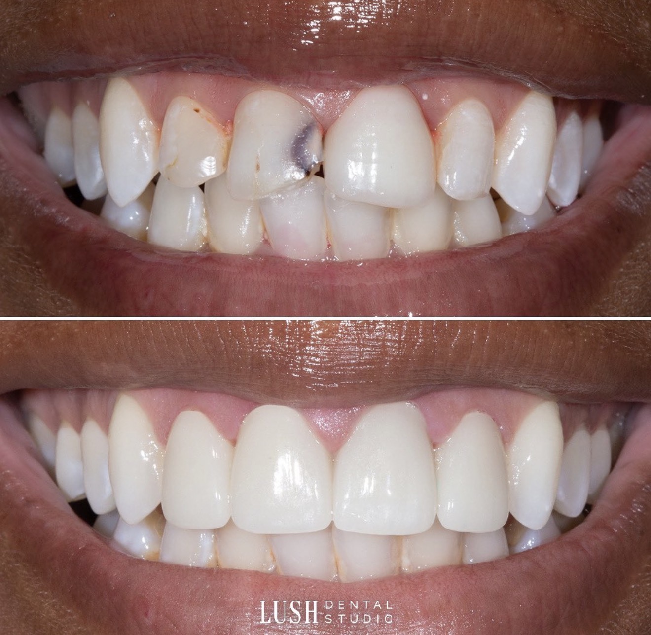 Smile transformation before and after at Lush Dental Studio Sacramento