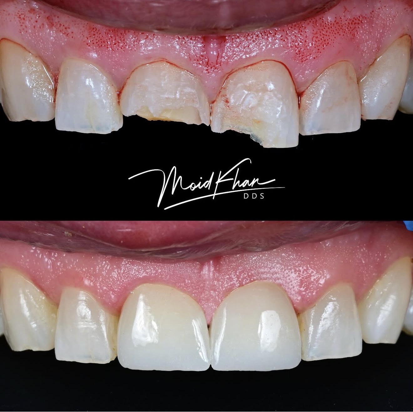 Cosmetic dentistry before and after at Lush Dental Studio Sacramento