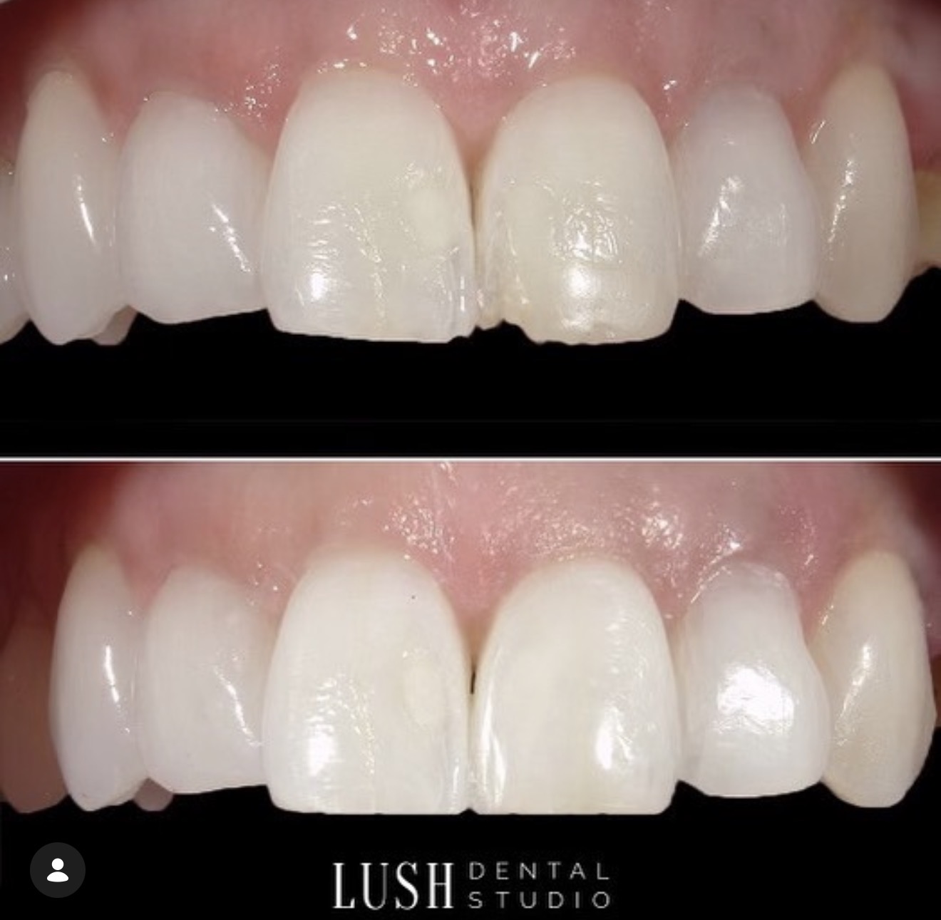 Veneer smile makeover before and after at Lush Dental Studio Sacramento